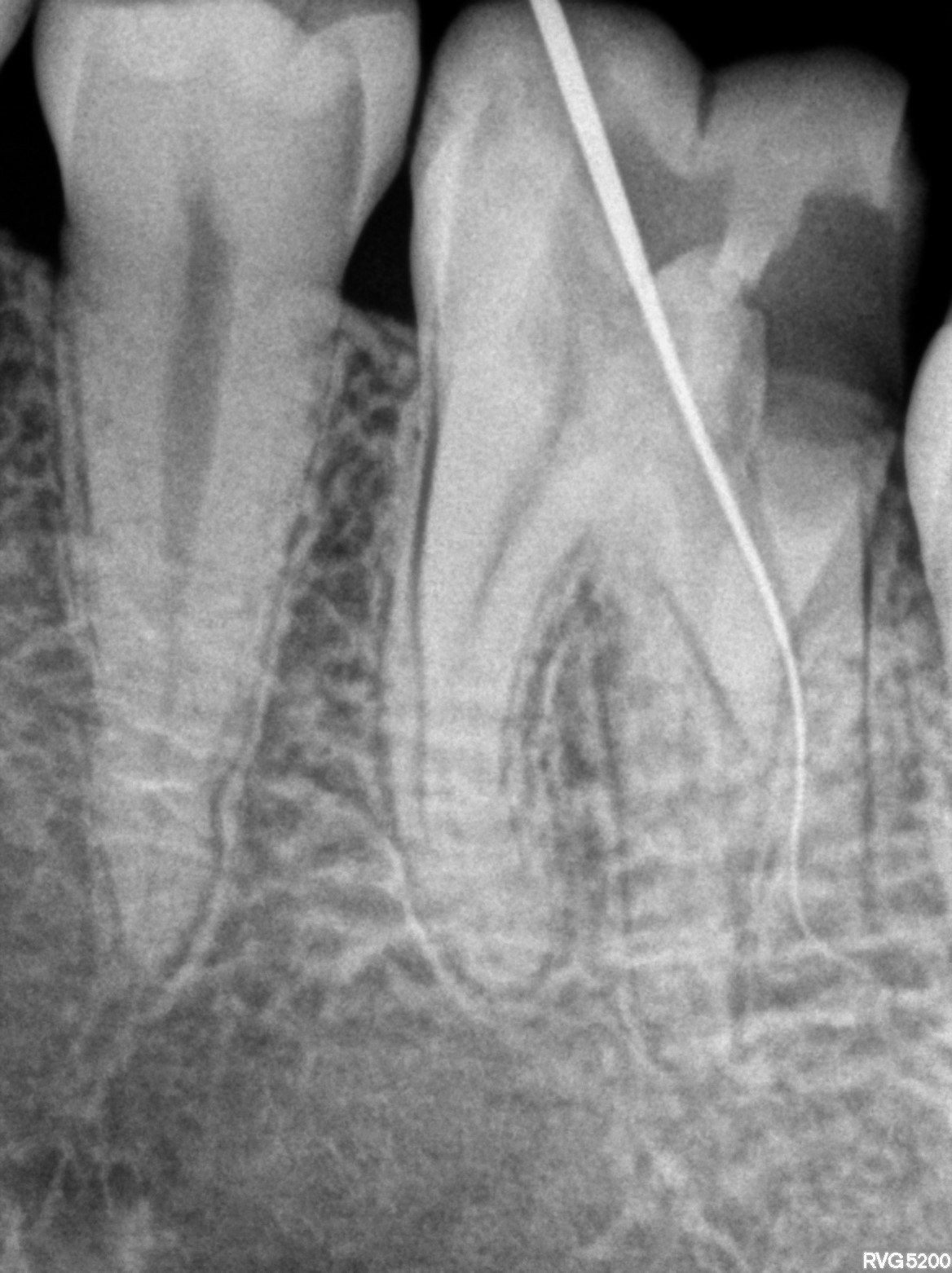 Dental X-ray